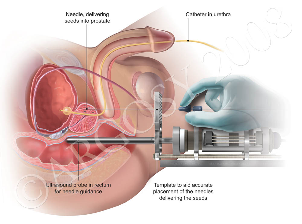 Cialis And Prostate Ablation